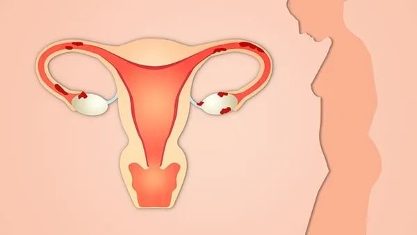 子宫内膜损伤会怀孕吗