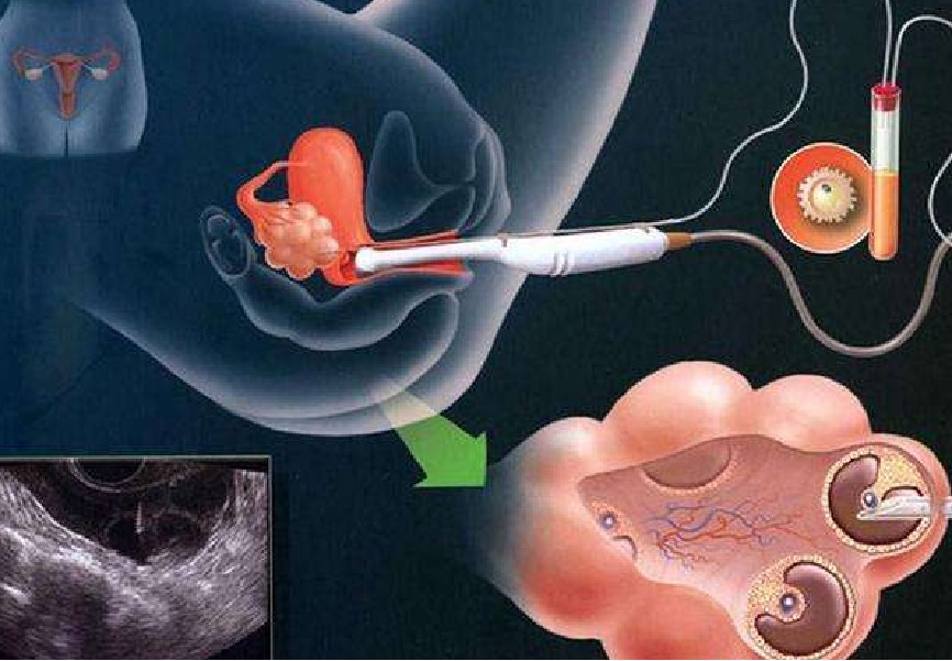 干细胞干预卵巢早衰