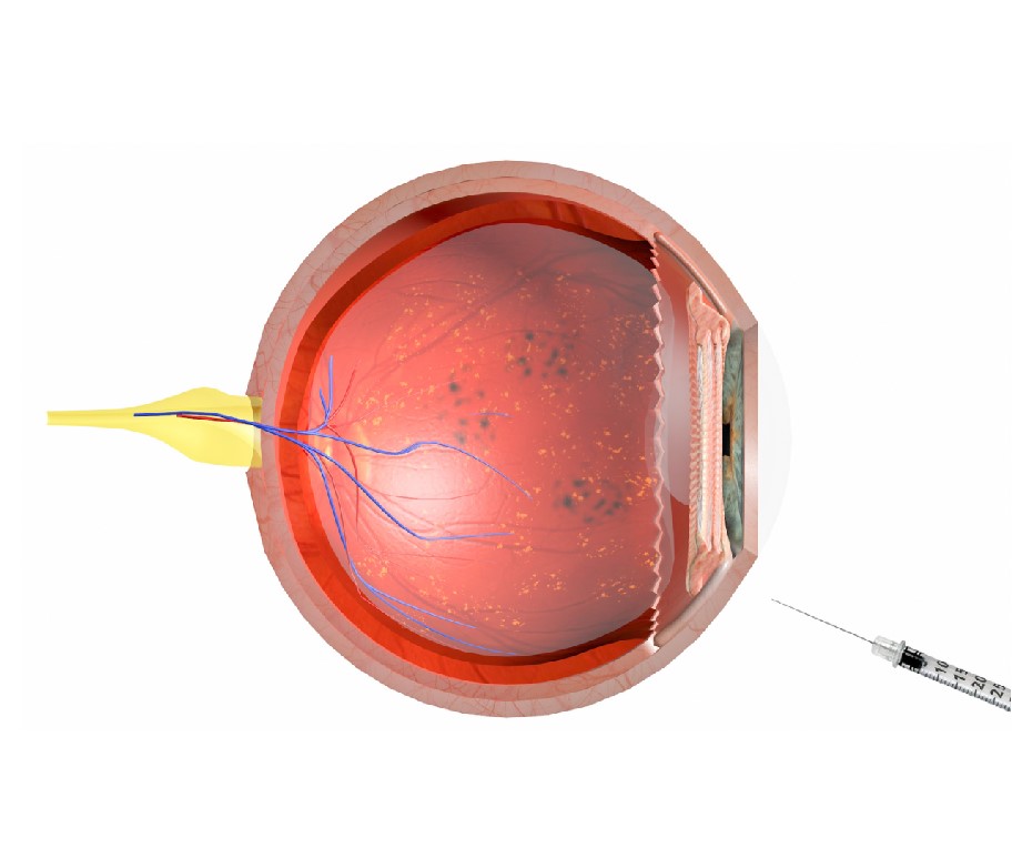 干细胞治疗眼部疾病