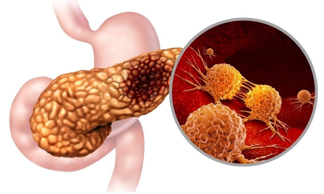 日媒：科学家发现导致胰腺癌转移的“癌干细胞”