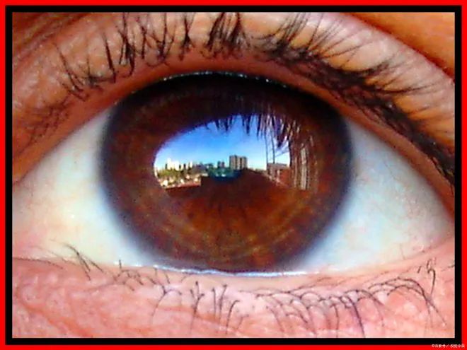 美国完成自体眼角膜干细胞重建，患者受伤5年后重见光明！