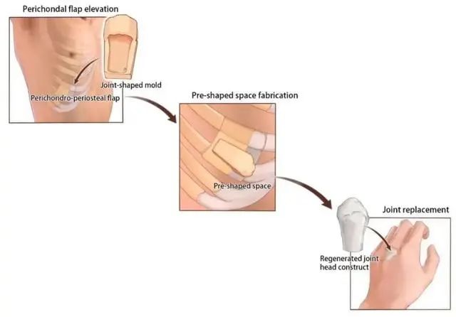 科学家让人体再生手指关节和耳软骨，提出再生医学应用新模式